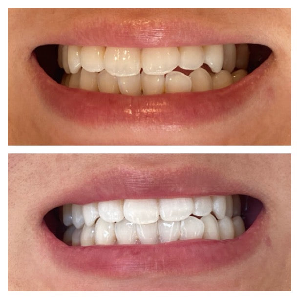 before and after results from teeth whitening